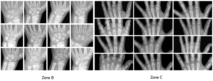 Neuromation：一文告訴你如何用CNN檢測兒童骨齡