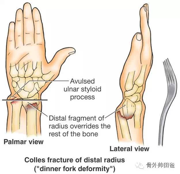 colles骨折:又称伸直型桡骨远端骨折,多为腕关节处於背伸位, 手掌著