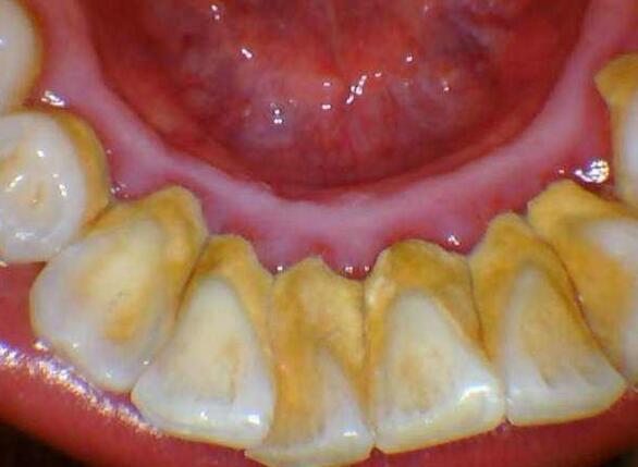 洗掉牙垢有几种方法?